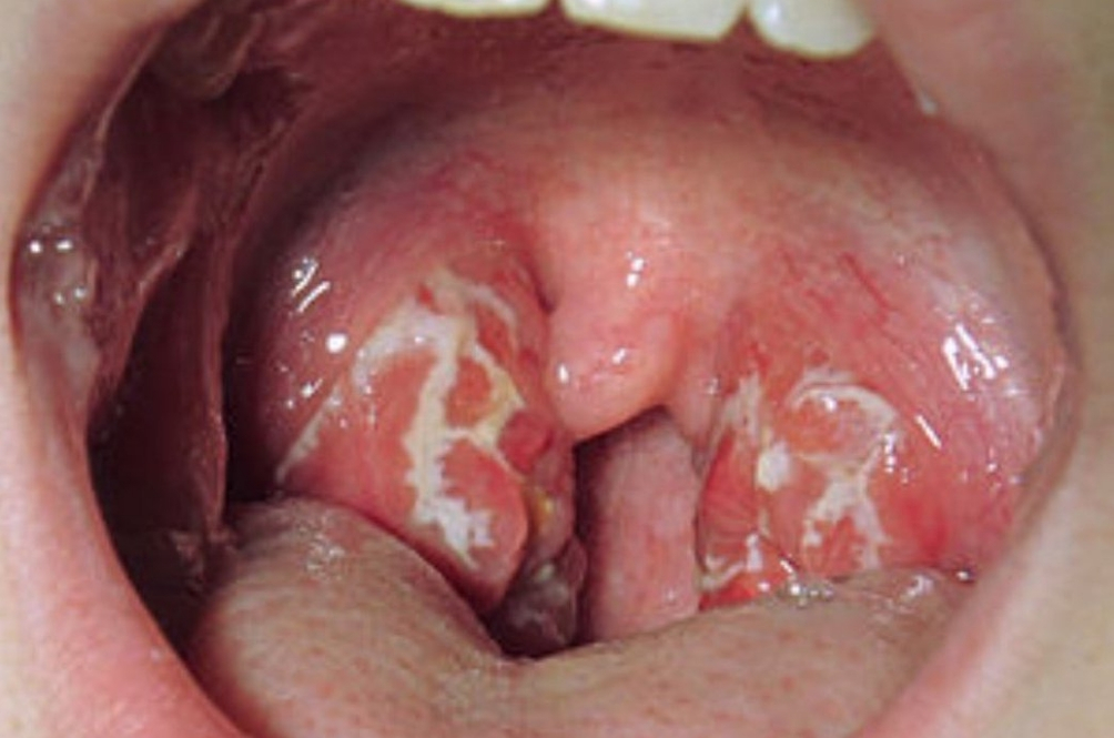 Kerap terkena tonsil? Inlah keadaan sebenarnya.