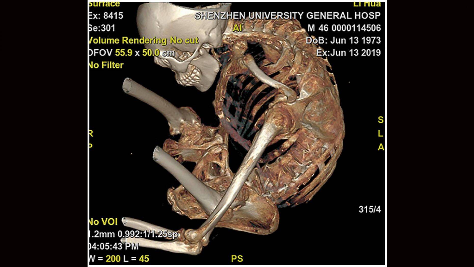 An X-ray of Li's spine.