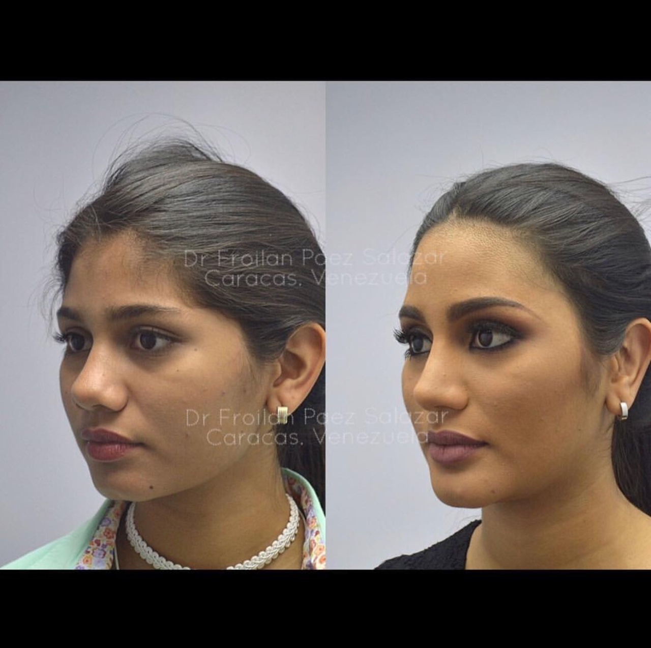 Naikkan tulang hidung dan panjangkan dagu.