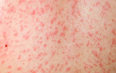 A severe case of measles