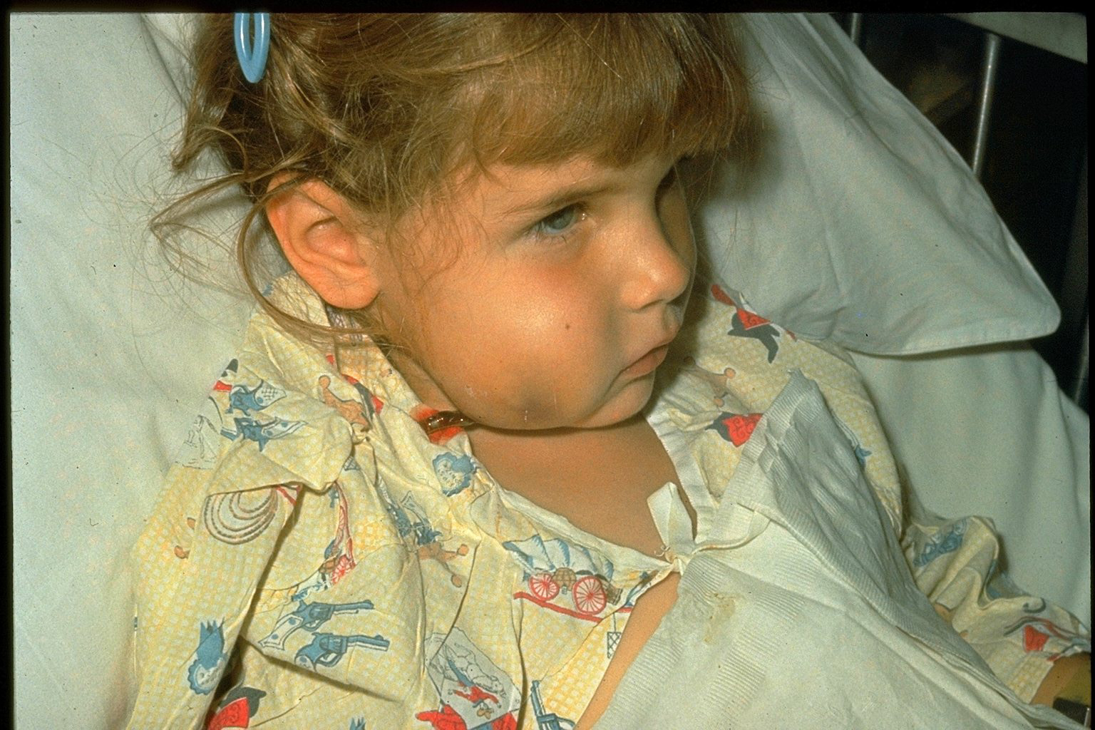 A child who's been infected with Hib
