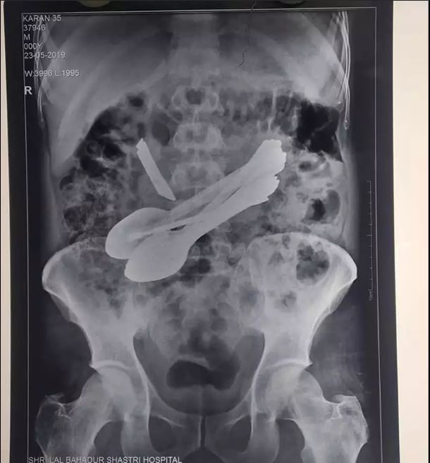 Lots of things in the stomach.