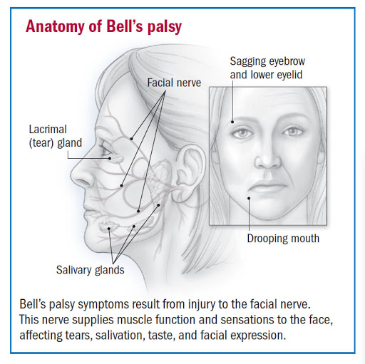 The symptoms of Bell's Palsy.
