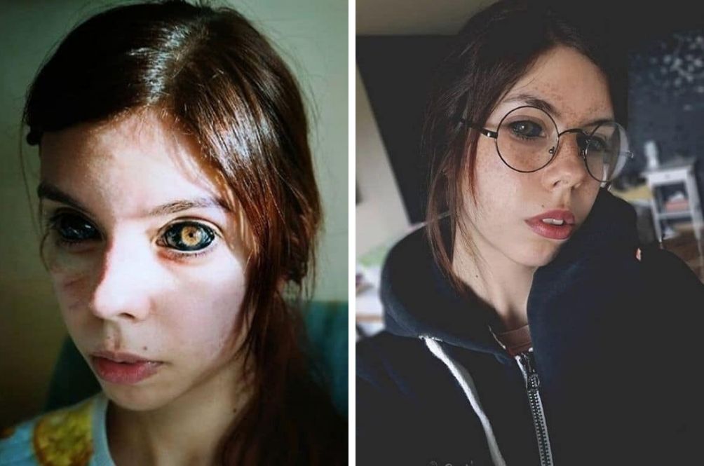 model-goes-blind.jpg