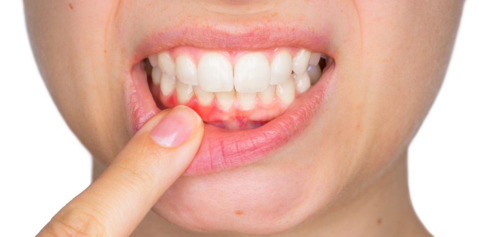 Do you experience bleeding gums when brushing?