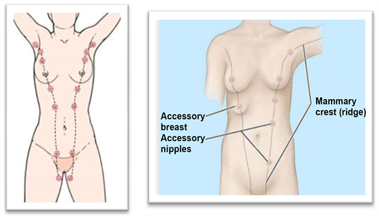 Polymastia can occur anywhere along these lines