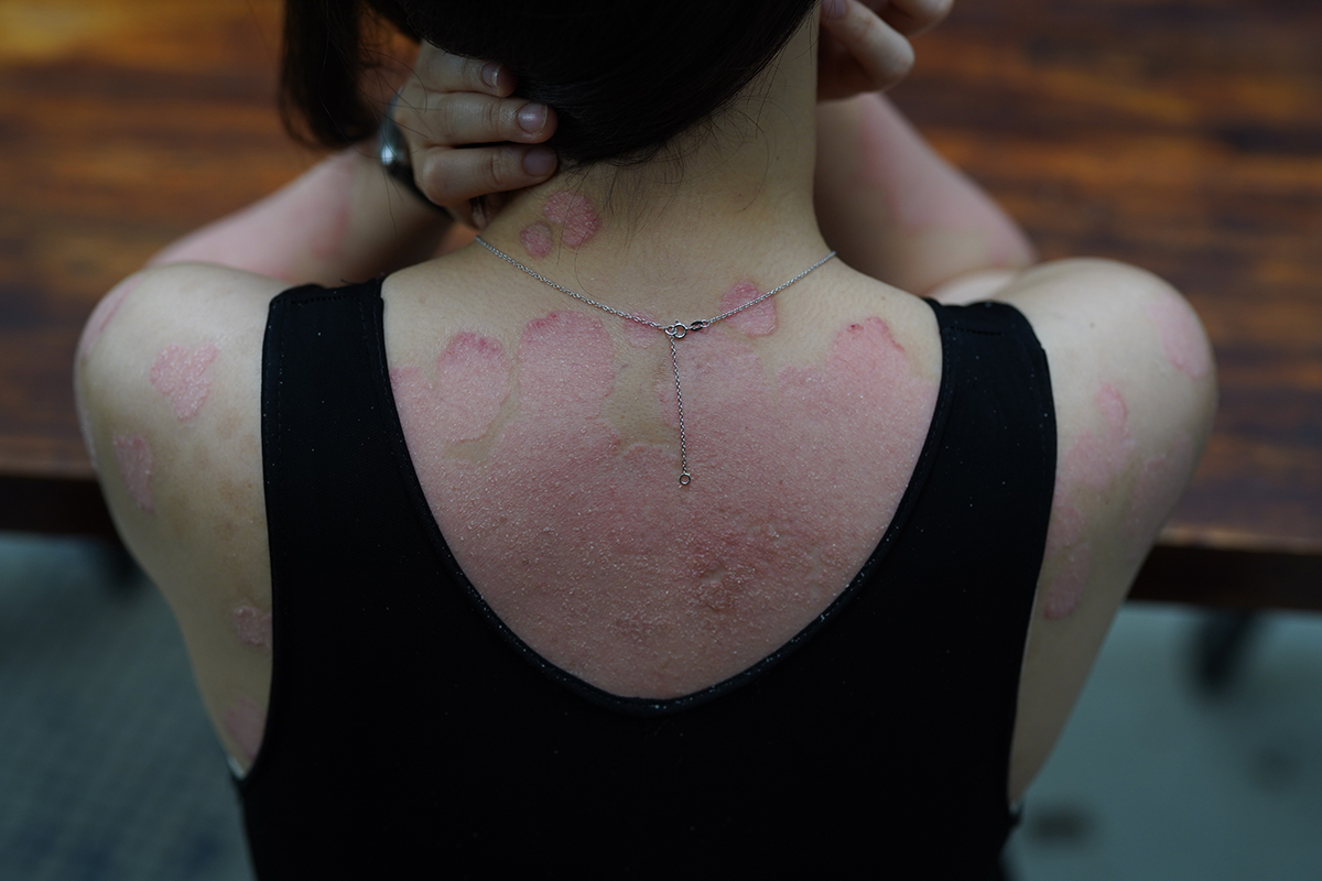 Rojak Daily/Afiqah Azizan Psoriasis is painful — both physically and mentally.