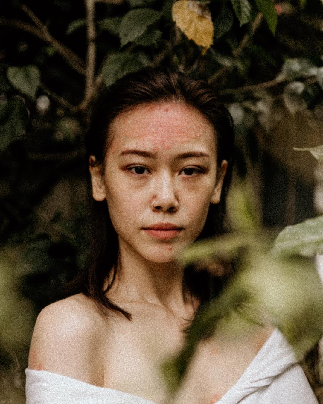 Instagram/rocyiewong Psoriasis gives Rocyie a purpose.