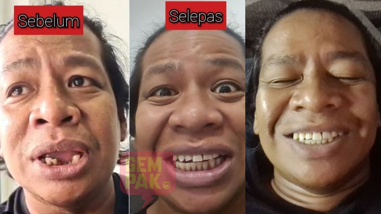 man-raja-lawak-dah-betulkan-gigi.jpg