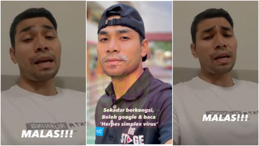 syafiq-farhain-herpes-simpleks.jpg