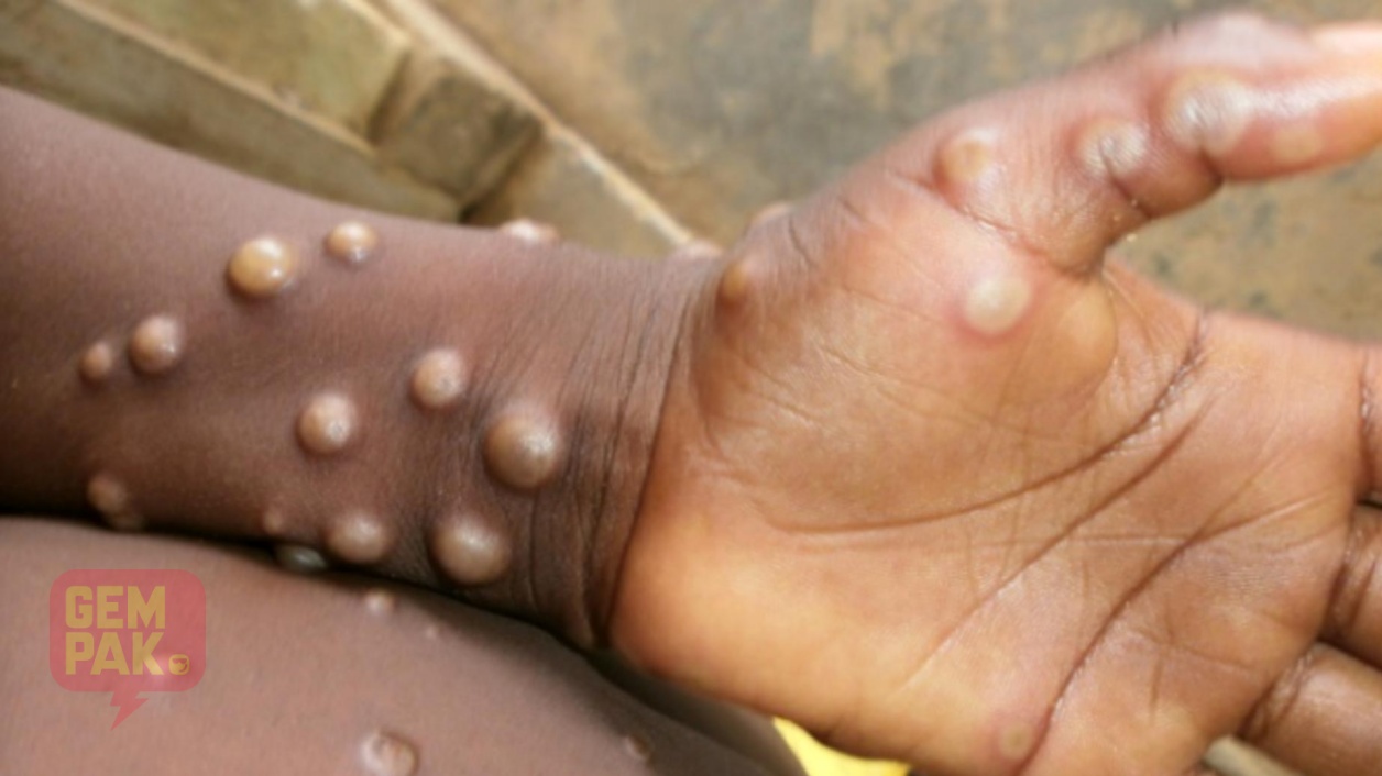 monkeypox_1.jpg