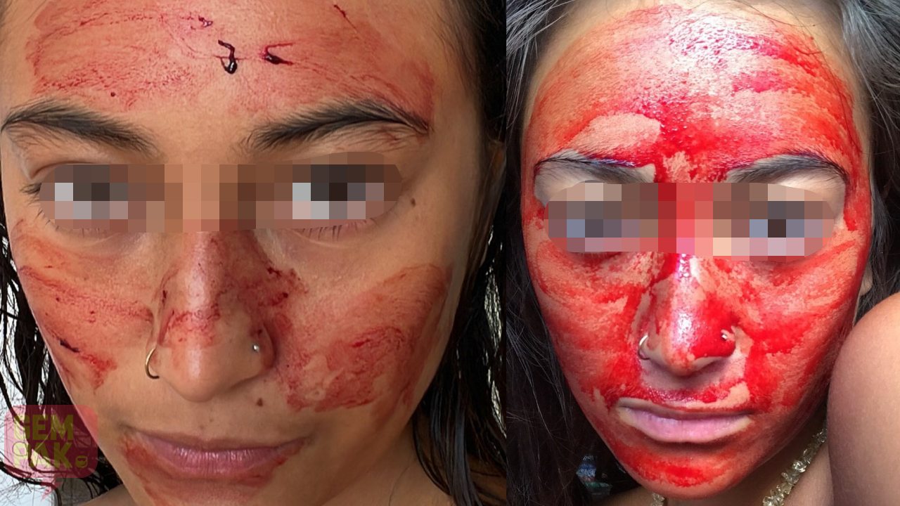 blood-facial.jpg
