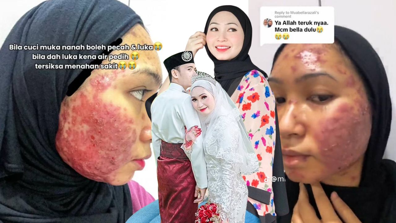 astro_gempak_jerawat_teruk.jpg