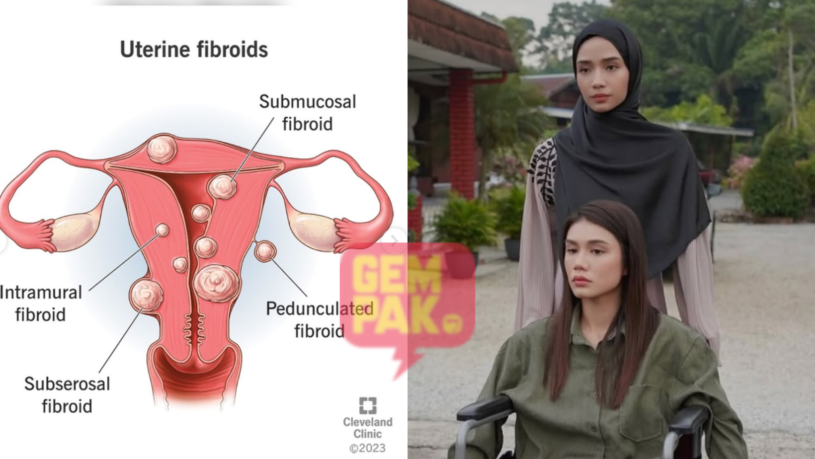 astrogempak_fibroid-ketumbuhan-tak-berbahaya.png