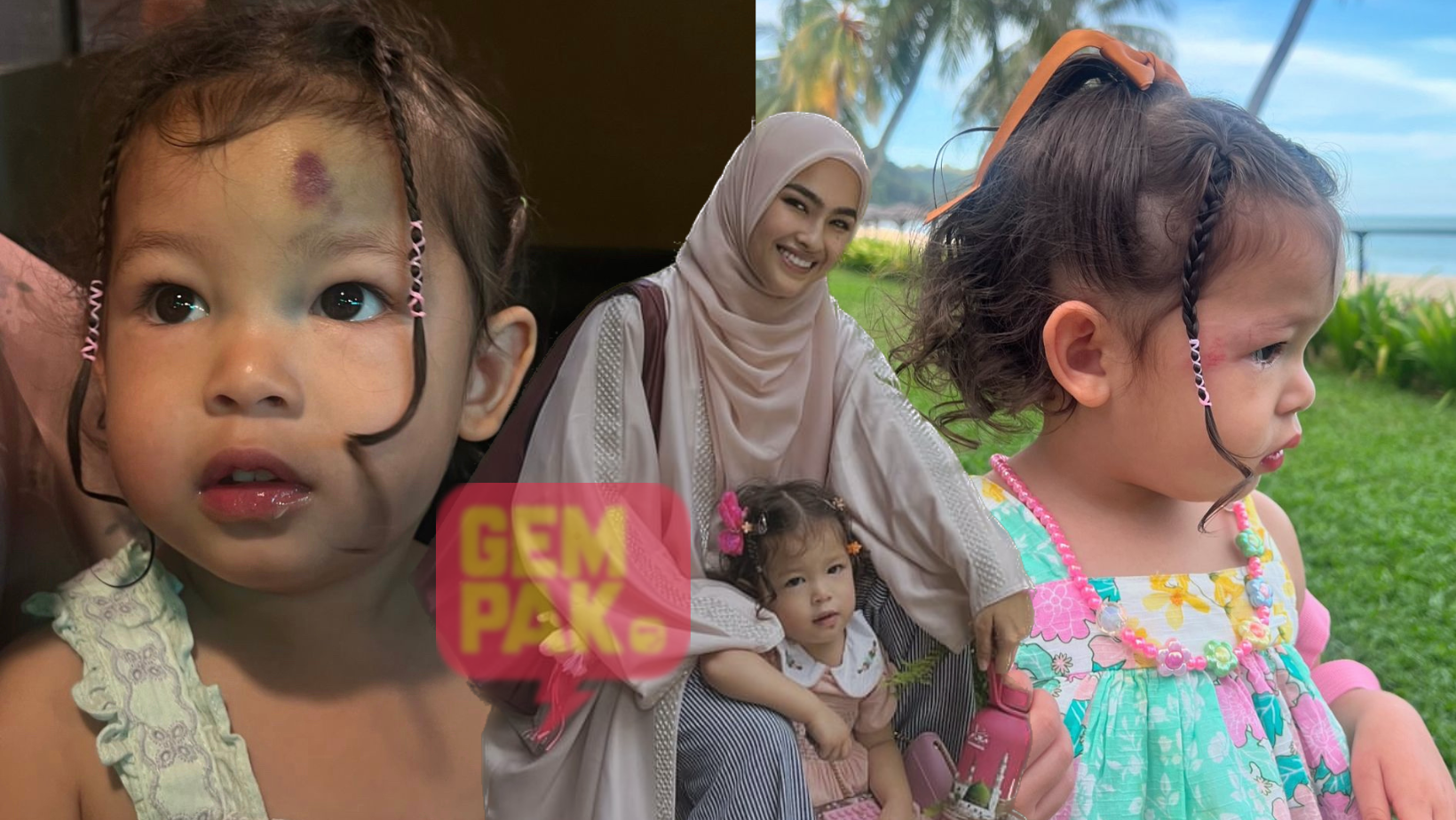astrogempak_anak-elfira-loy-alami-lebam.png