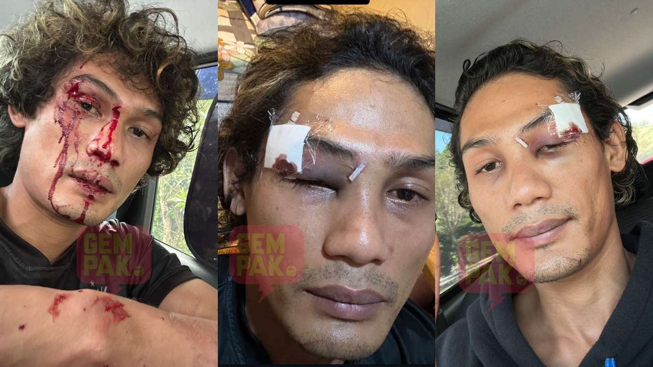astro_gempak_fadhli-masoot-kemalangan-terima-enam-jahitan-di-bahagian-kelopak-mata.jpg