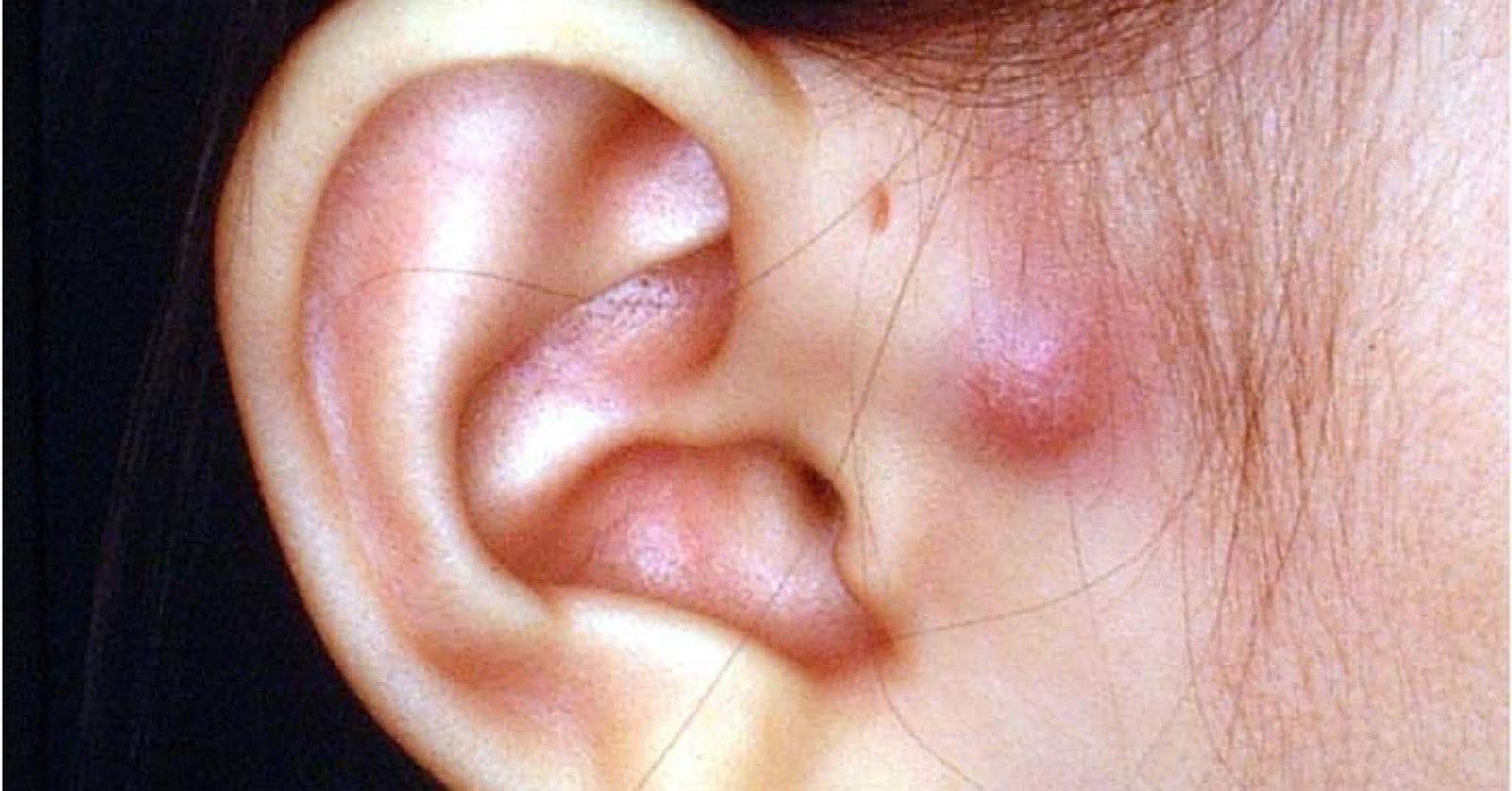 preauricular-sinus-3.jpg
