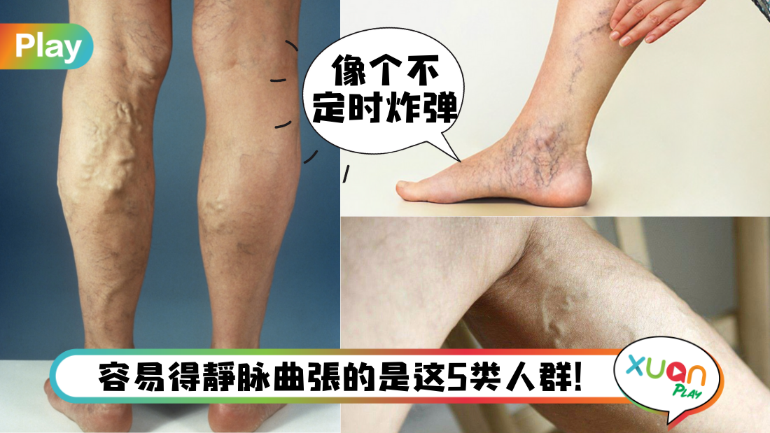 leg-veins.png