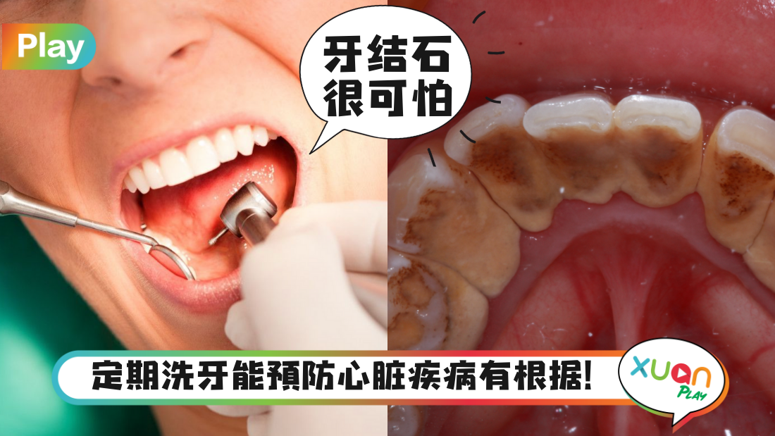 teeth-cleaning.png