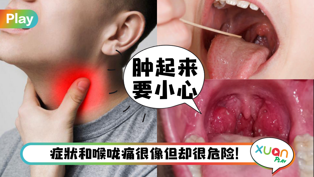 tonsils.png