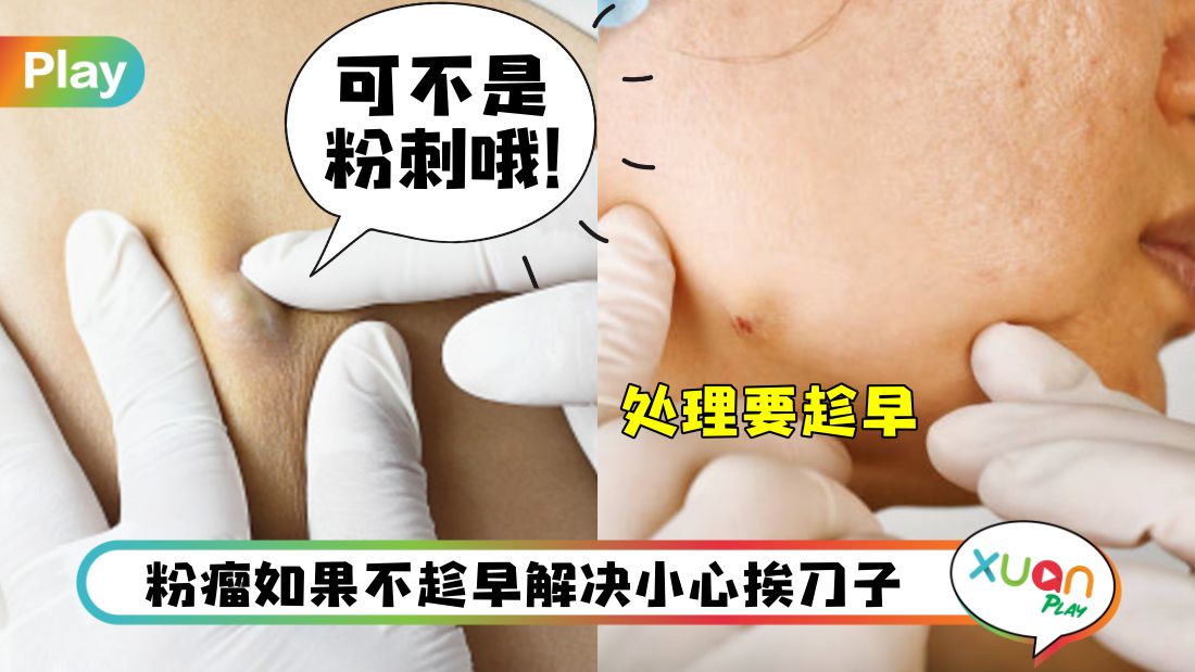 face-epidermal-cyst.jpg