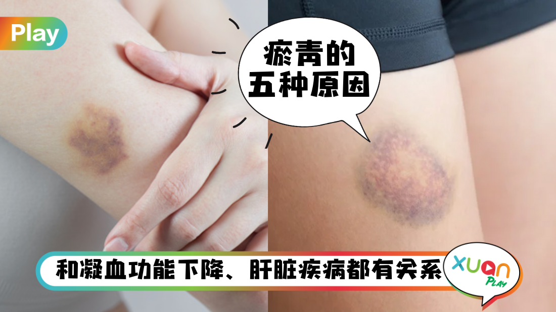 why-bruises.png