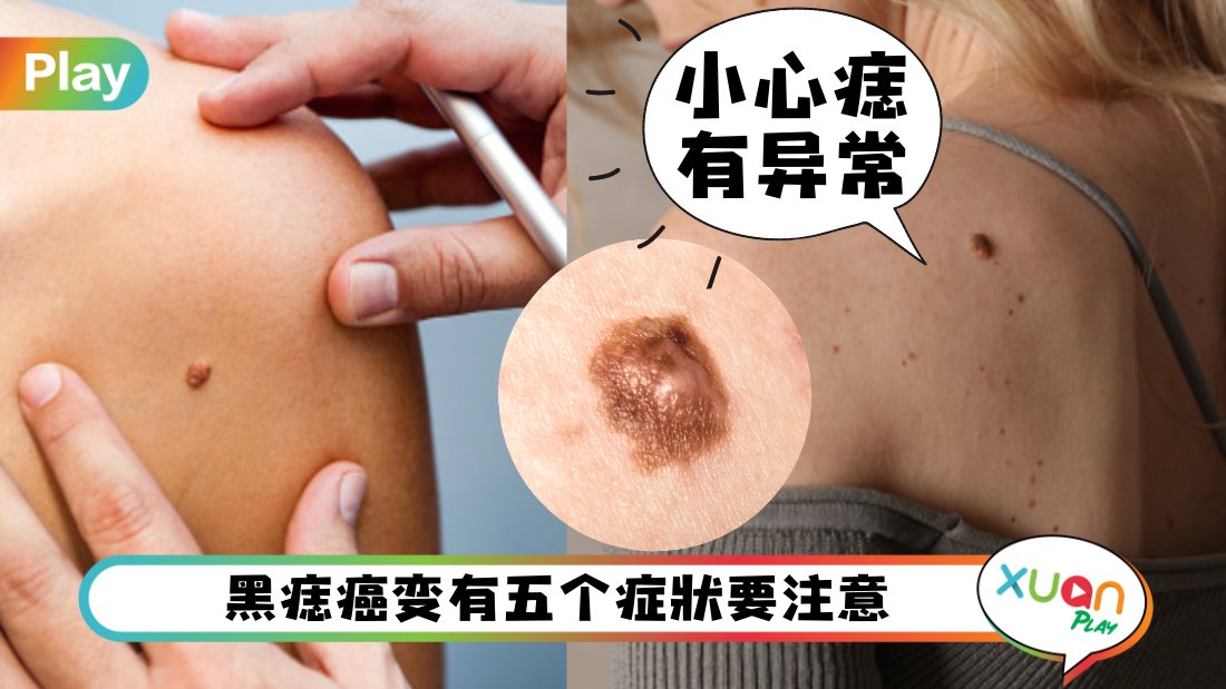 what-cause-mole.jpg
