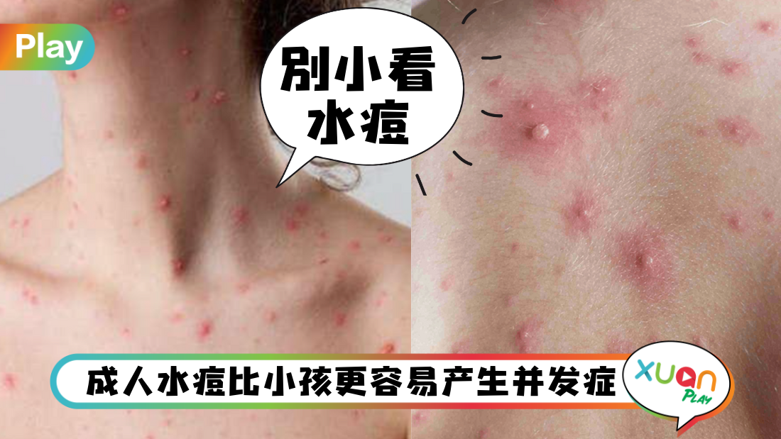 chickenpox.png