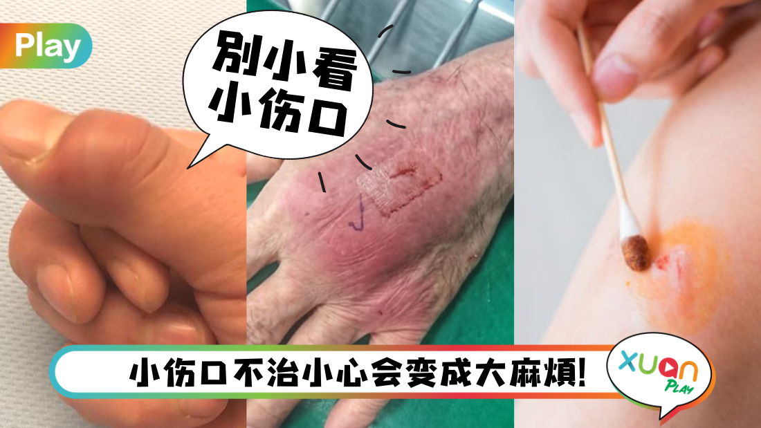 cellulitis.png