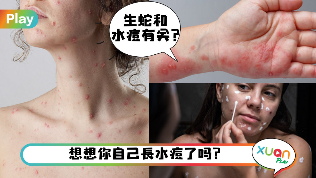 chickenpox.png