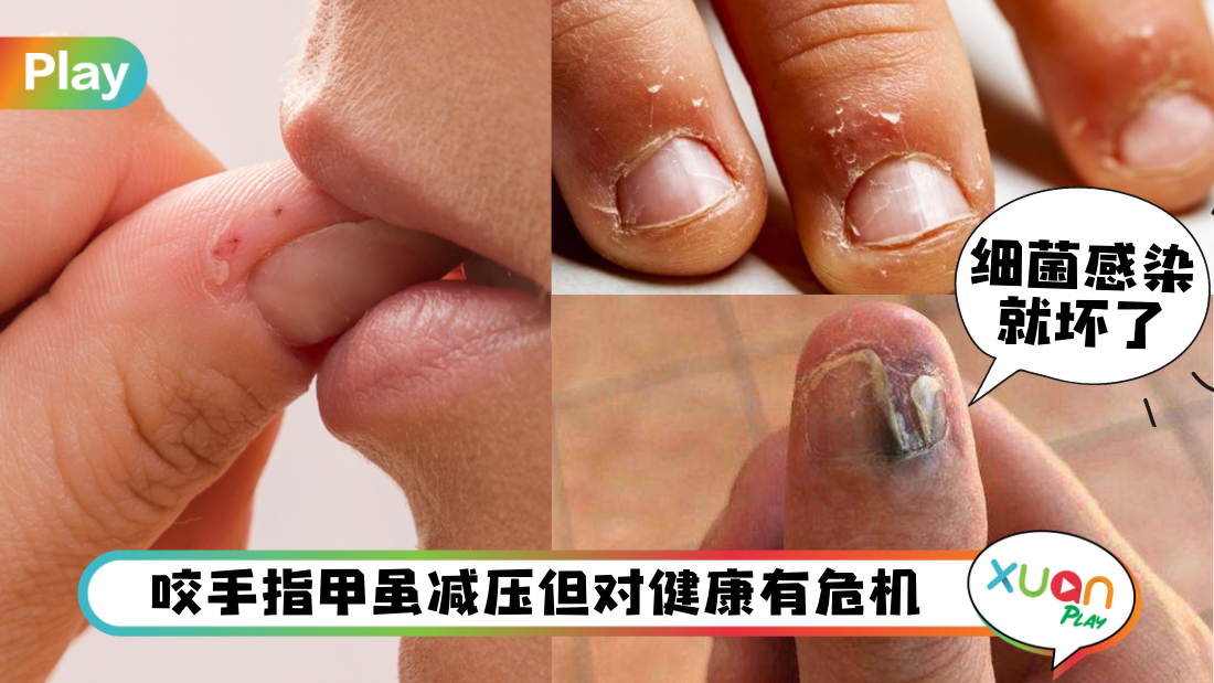 nail-bite.png