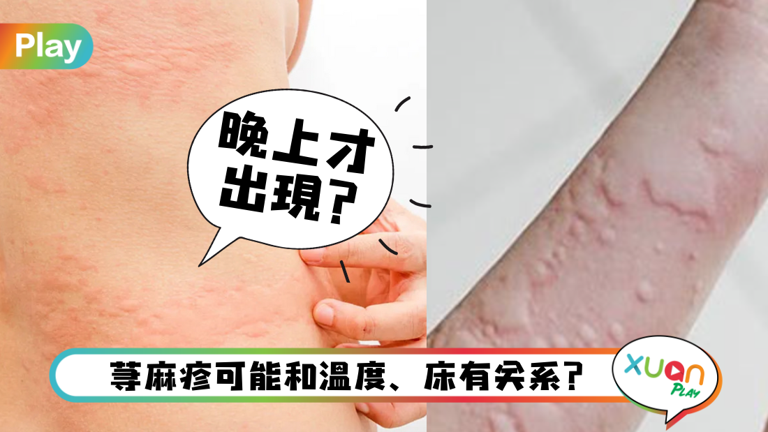 reason-of-hives.png
