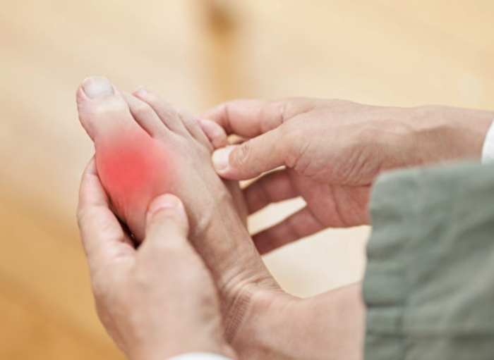 尿酸导致脚关节痛风