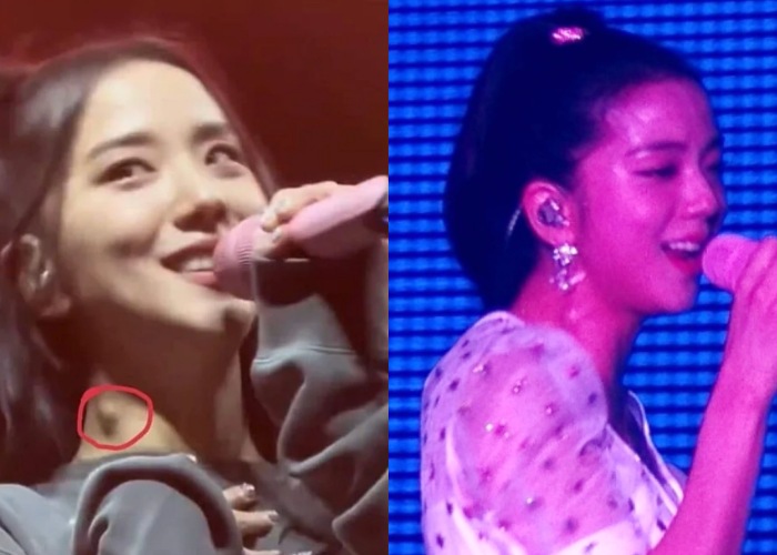 Blackpink Jisoo 脖子淋巴结