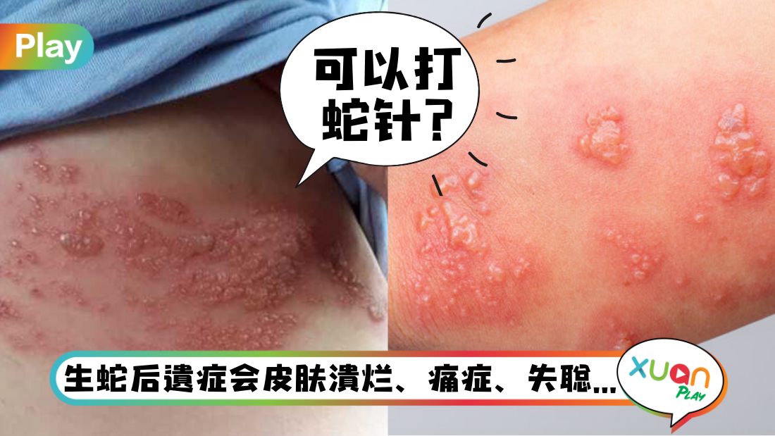 side-effect-of-covid-19-shingles.jpg