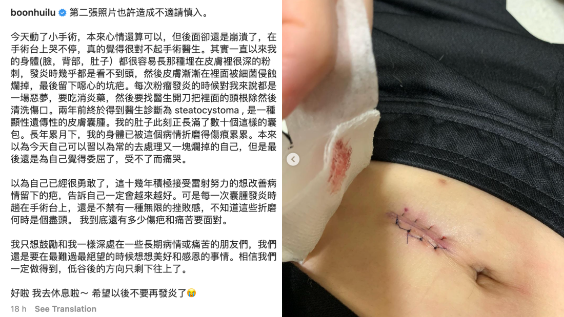 文慧如肚子长满囊包