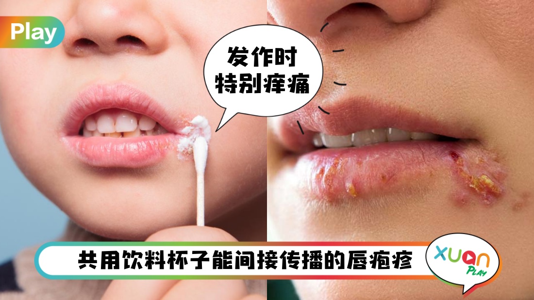 cold-sore.jpg