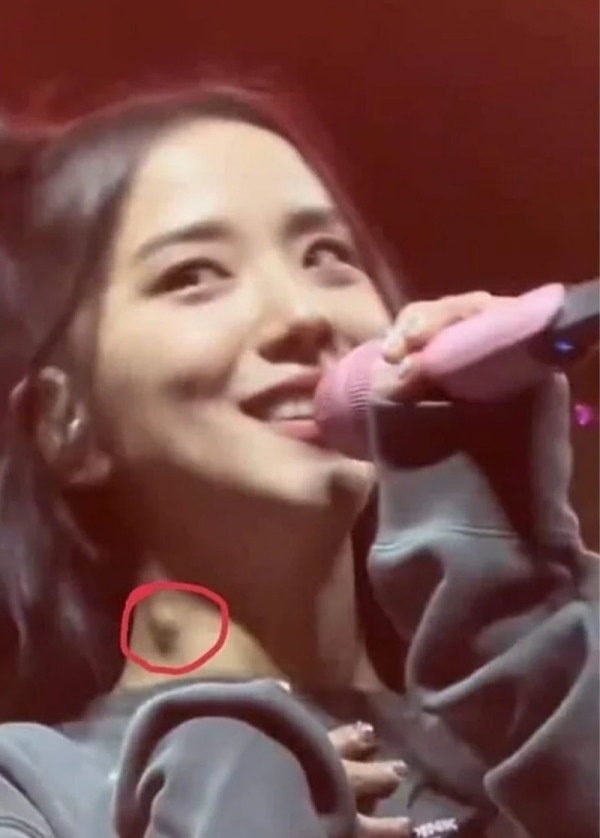 Jisoo脖子肿一块