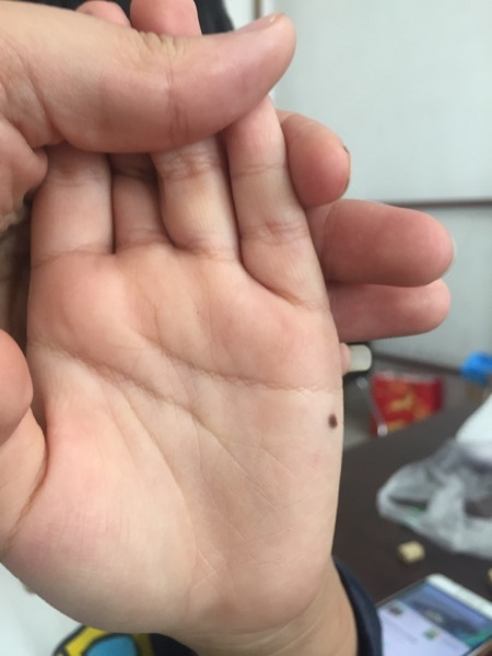 hand-palm-mole