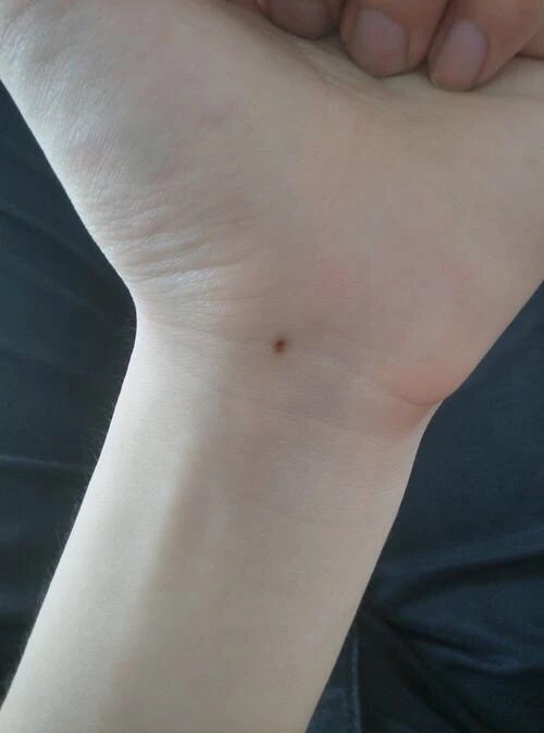 wrist-mole