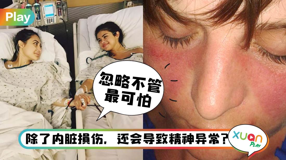 sle-lupus.jpg