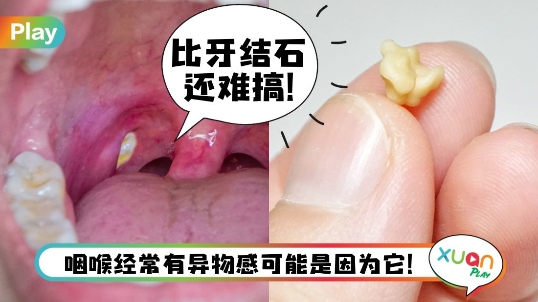 what-is-tonsil-stones.jpg