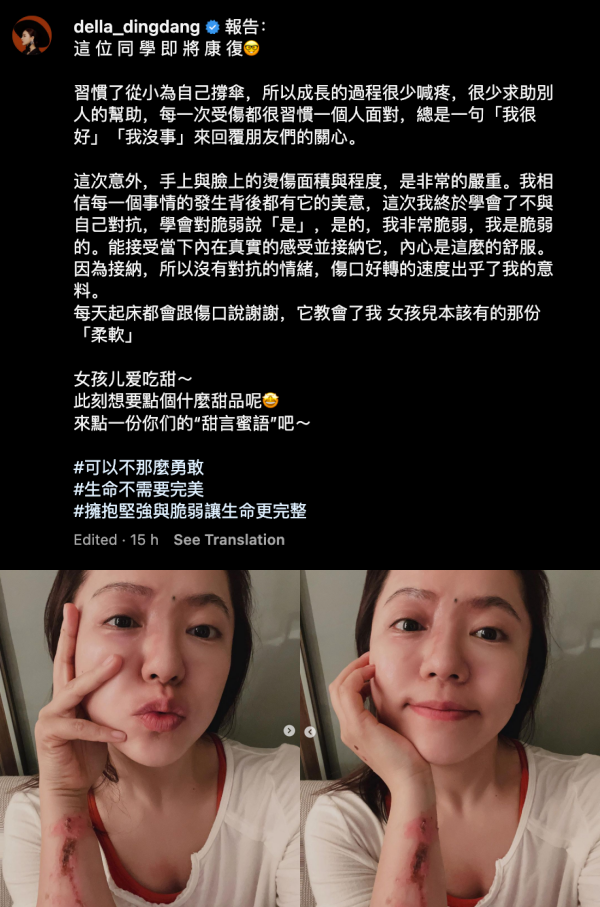 丁当晒伤势