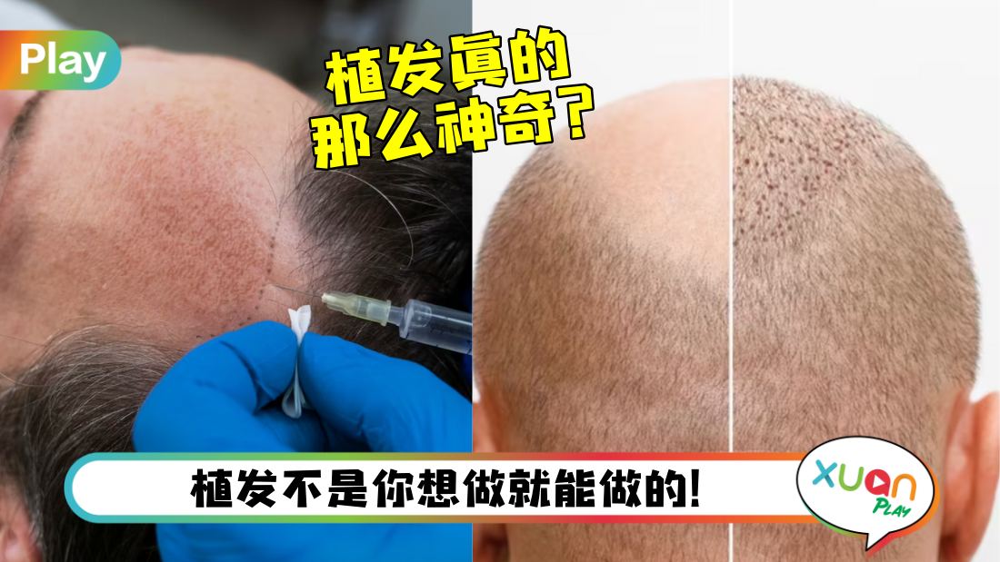 scalp-hair-transplant.jpg
