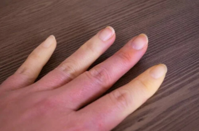 雷诺氏综合症也会导致手指肿胀