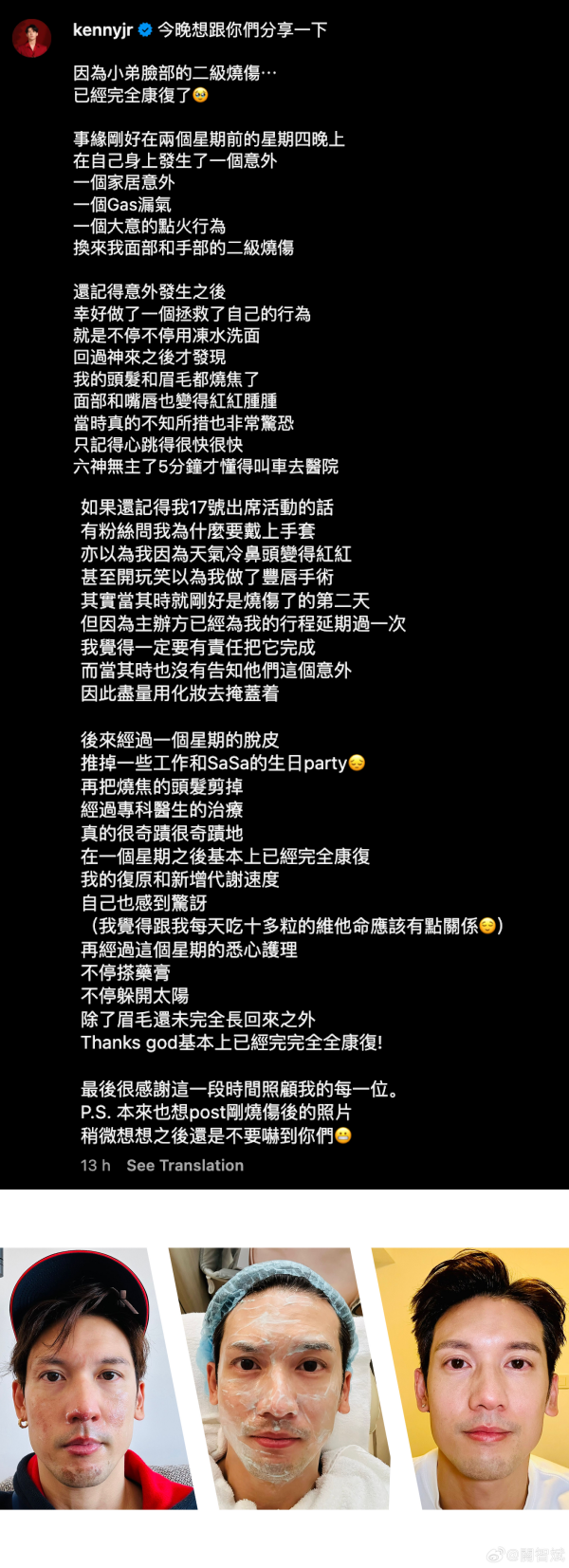 关智斌被二级烧伤
