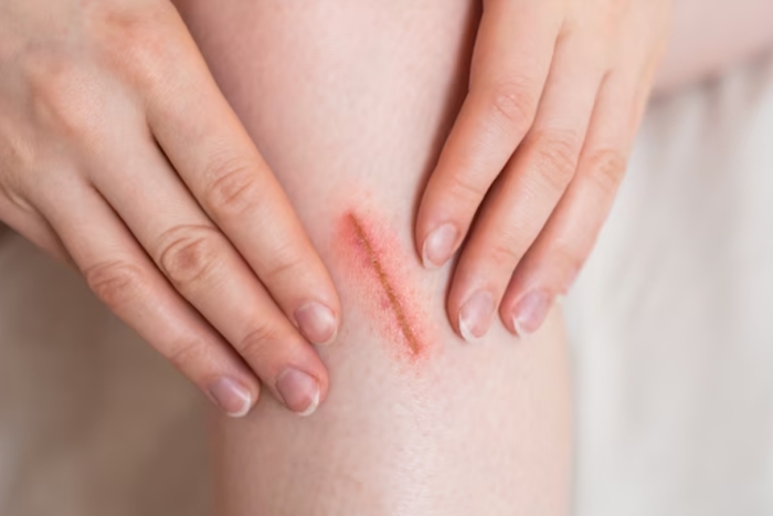 太深的伤口不适合用创可贴