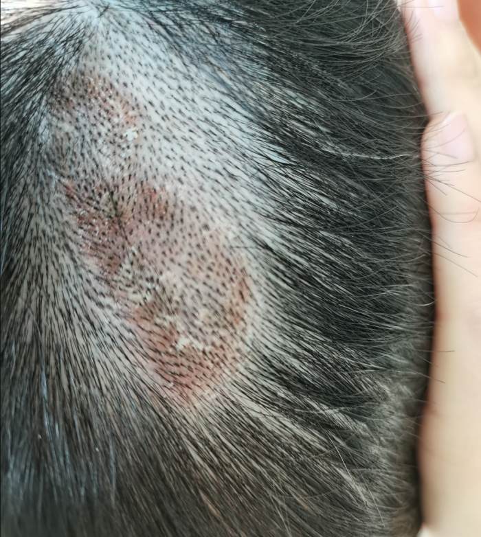 头皮真菌导致发炎红肿