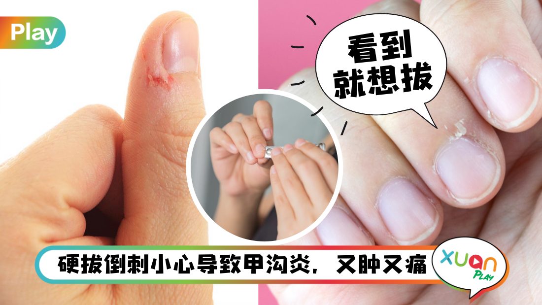 what-cause-hangnails.jpg