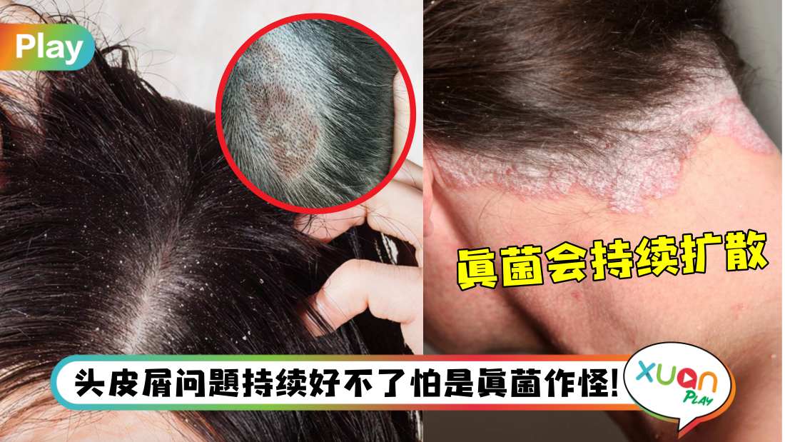 what-cause-tinea-capitis.jpg